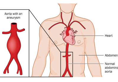 Read more about Men aged over 65 urged to have potentially lifesaving scan